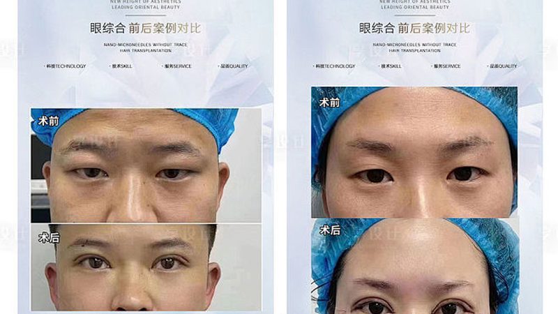 超声炮国产与进口：技术解析与选型要点