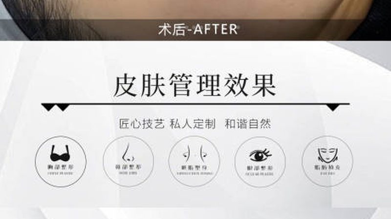 光子嫩肤术后洗脸攻略：哪些细节要注意？**