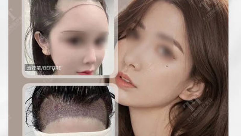 国产玻尿酸与进口玻尿酸：价格背后的差异解析