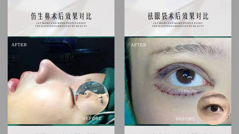 隆鼻术前准备，这些关键步骤你了解吗？**