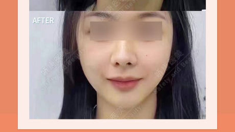 热玛吉：面部与眼部联合治疗，效果如何？**