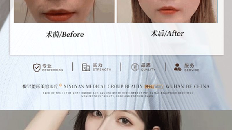 IPL激光祛斑仪：揭秘其原理与选购要点