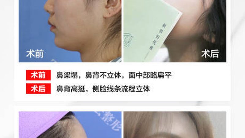 小标题：了解水光针恢复期，避免术后困扰