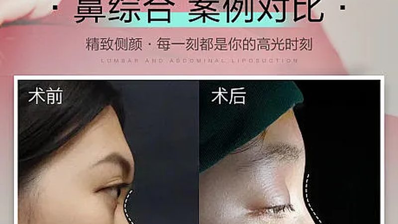 如何打造面部立体感？隆鼻协调参数解析