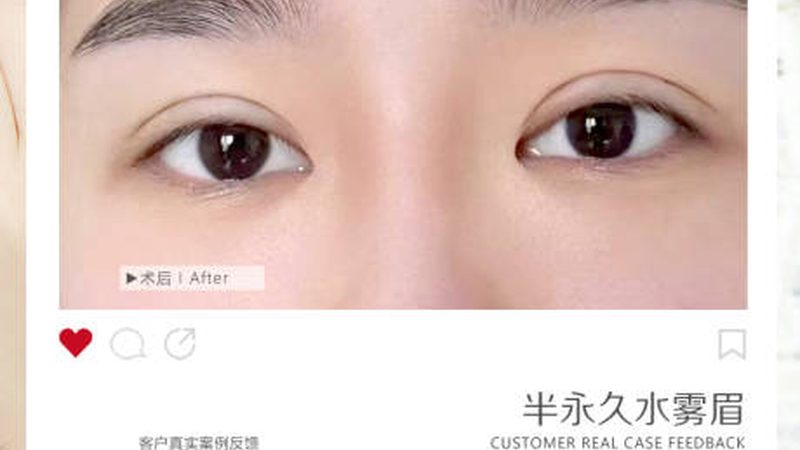 玻尿酸注射后注意事项副作用