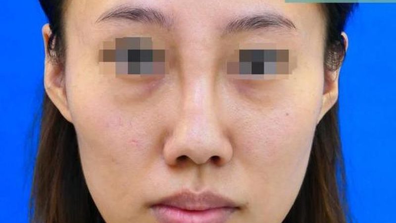 鼻翼缩小术后，这些注意事项你了解吗？**